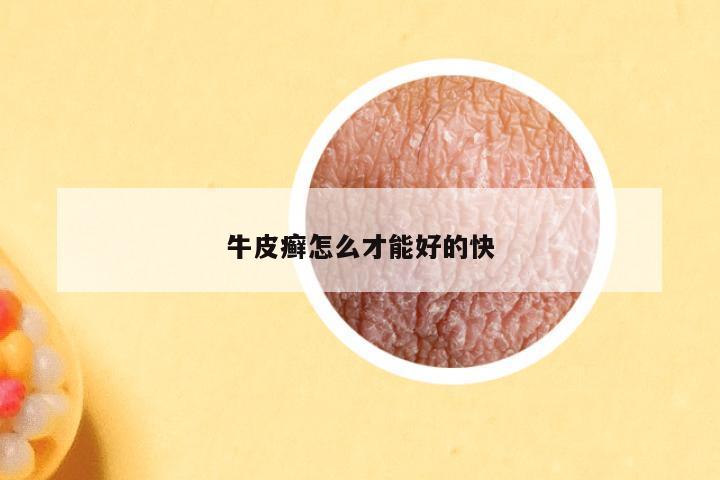 牛皮癣怎么才能好的快