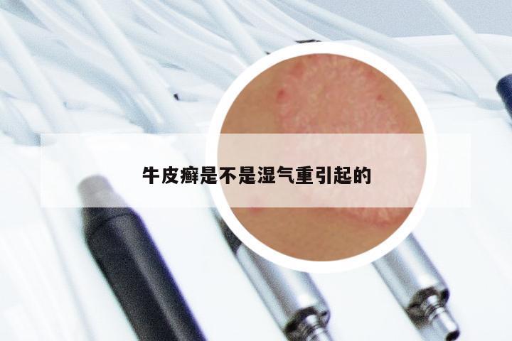 牛皮癣是不是湿气重引起的