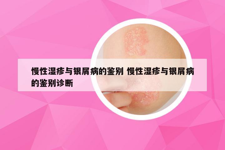 慢性湿疹与银屑病的鉴别 慢性湿疹与银屑病的鉴别诊断