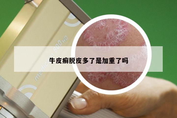 牛皮癣脱皮多了是加重了吗