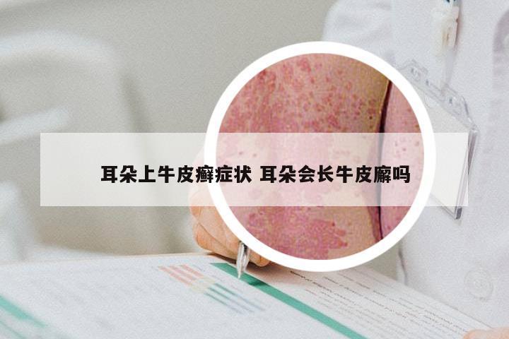 耳朵上牛皮癣症状 耳朵会长牛皮廨吗