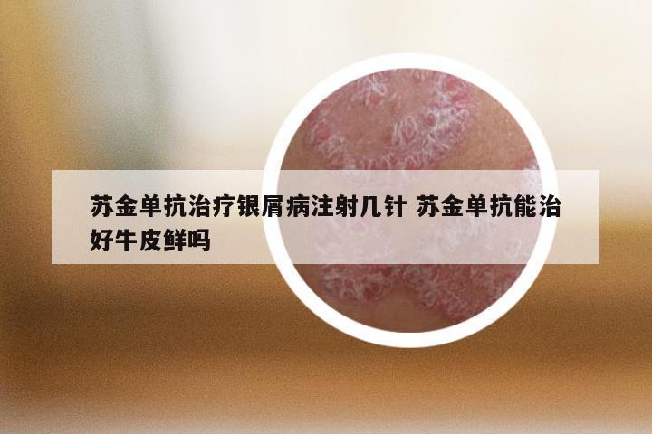 苏金单抗治疗银屑病注射几针 苏金单抗能治好牛皮鲜吗