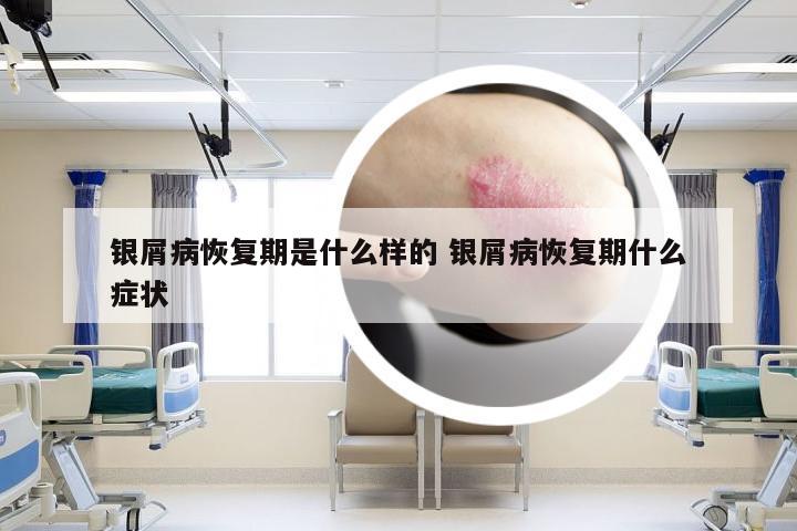 银屑病恢复期是什么样的 银屑病恢复期什么症状