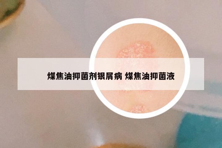 煤焦油抑菌剂银屑病 煤焦油抑菌液