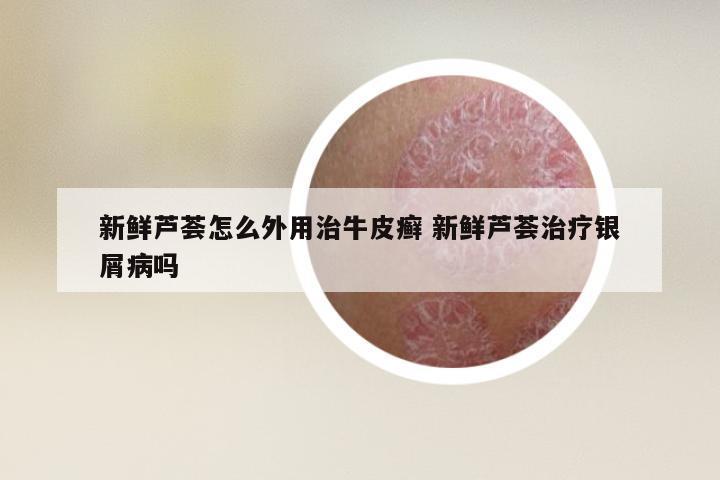 新鲜芦荟怎么外用治牛皮癣 新鲜芦荟治疗银屑病吗