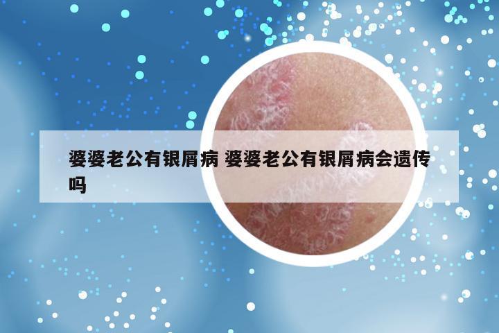 婆婆老公有银屑病 婆婆老公有银屑病会遗传吗