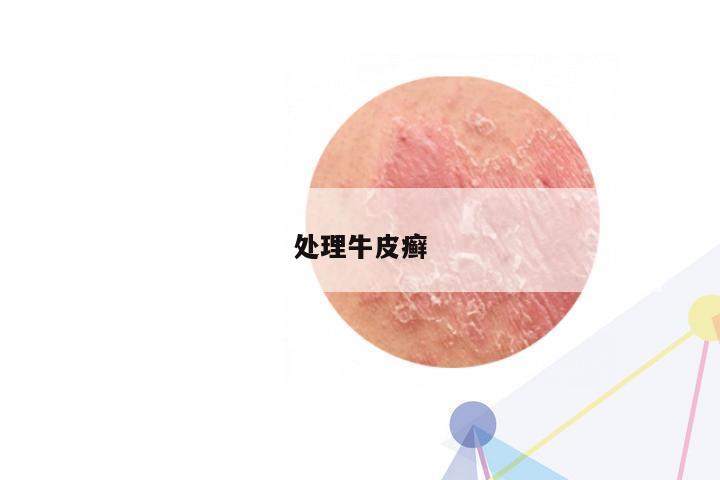 处理牛皮癣