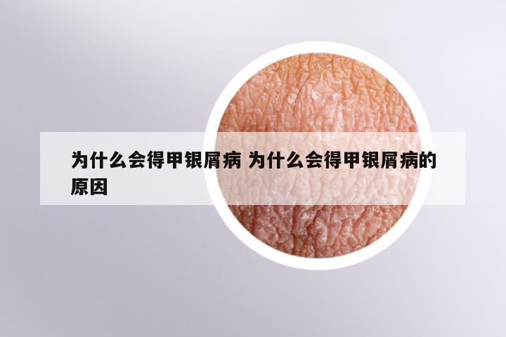 为什么会得甲银屑病 为什么会得甲银屑病的原因