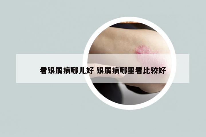 看银屑病哪儿好 银屑病哪里看比较好