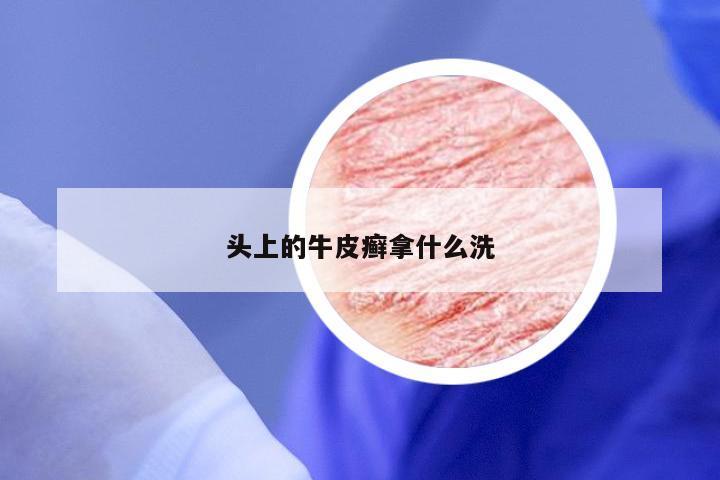 头上的牛皮癣拿什么洗