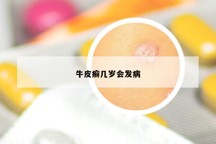 牛皮癣几岁会发病