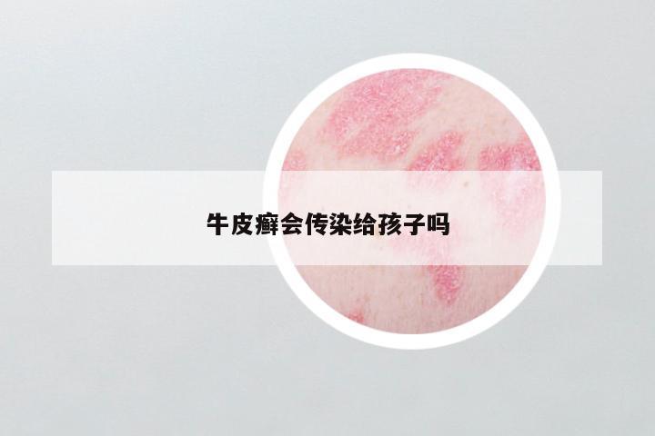 牛皮癣会传染给孩子吗