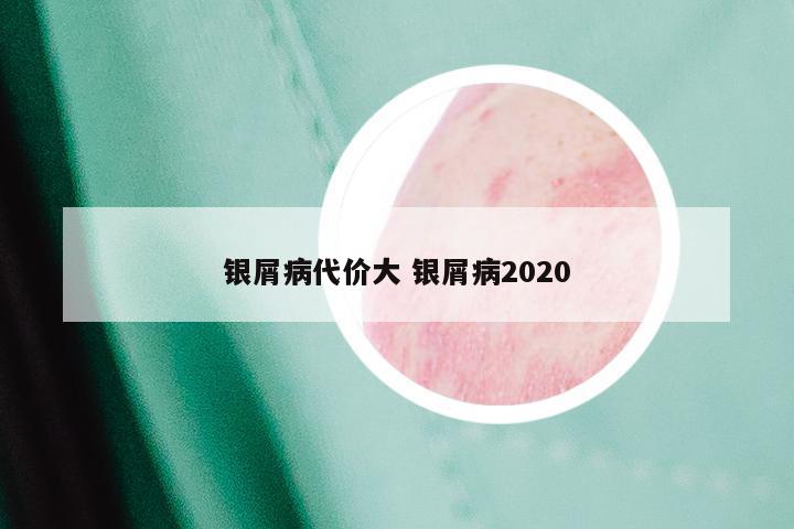 银屑病代价大 银屑病2020