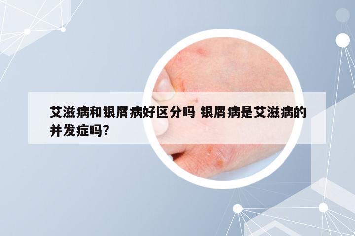 艾滋病和银屑病好区分吗 银屑病是艾滋病的并发症吗?
