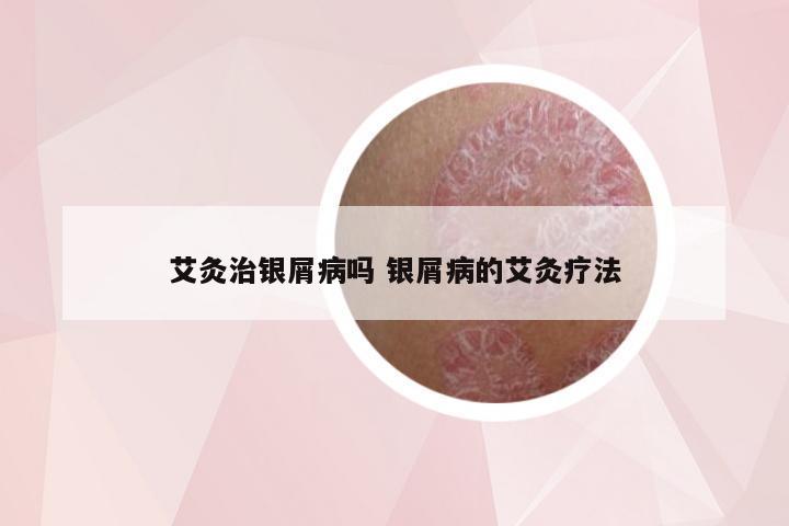 艾灸治银屑病吗 银屑病的艾灸疗法