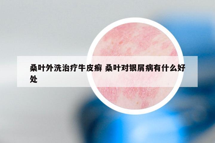 桑叶外洗治疗牛皮癣 桑叶对银屑病有什么好处