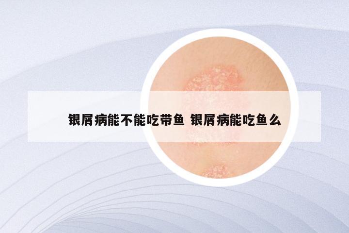 银屑病能不能吃带鱼 银屑病能吃鱼么