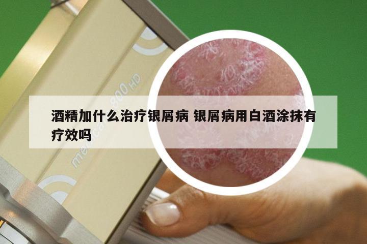 酒精加什么治疗银屑病 银屑病用白酒涂抹有疗效吗