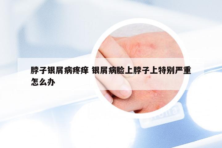 脖子银屑病疼痒 银屑病脸上脖子上特别严重怎么办
