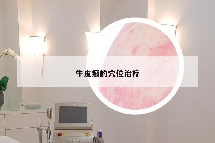 牛皮癣的穴位治疗