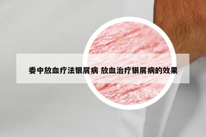委中放血疗法银屑病 放血治疗银屑病的效果