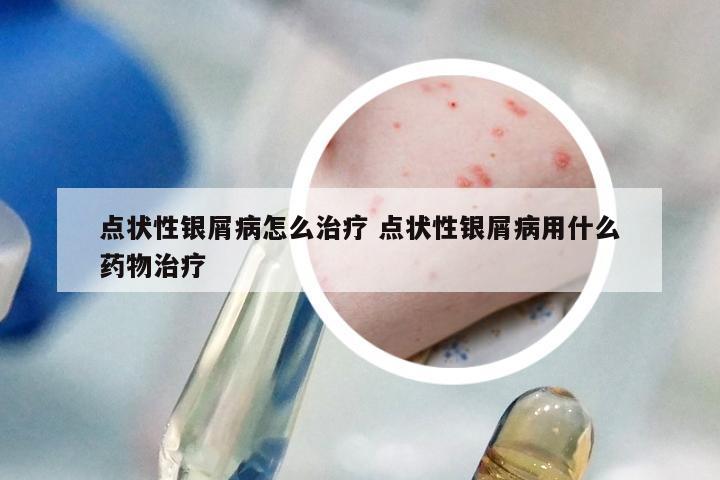 点状性银屑病怎么治疗 点状性银屑病用什么药物治疗