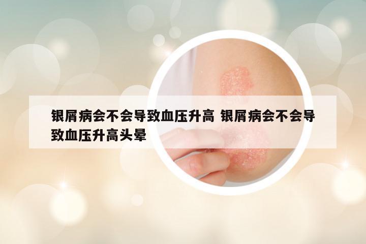 银屑病会不会导致血压升高 银屑病会不会导致血压升高头晕