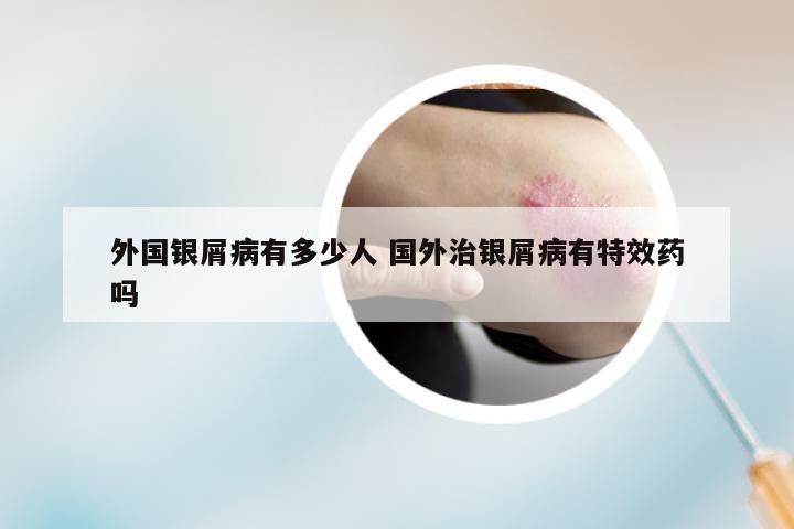 外国银屑病有多少人 国外治银屑病有特效药吗