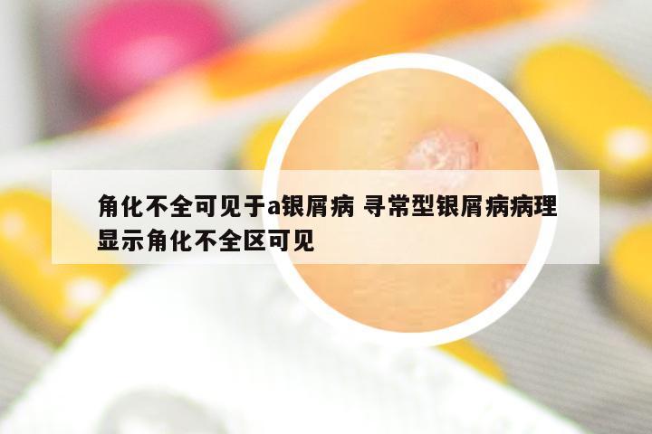 角化不全可见于a银屑病 寻常型银屑病病理显示角化不全区可见