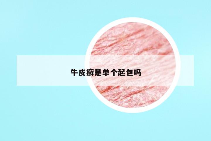牛皮癣是单个起包吗