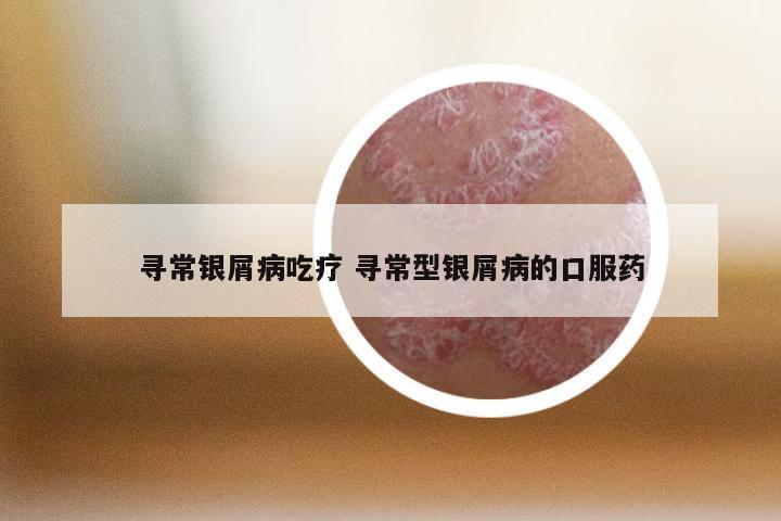 寻常银屑病吃疗 寻常型银屑病的口服药