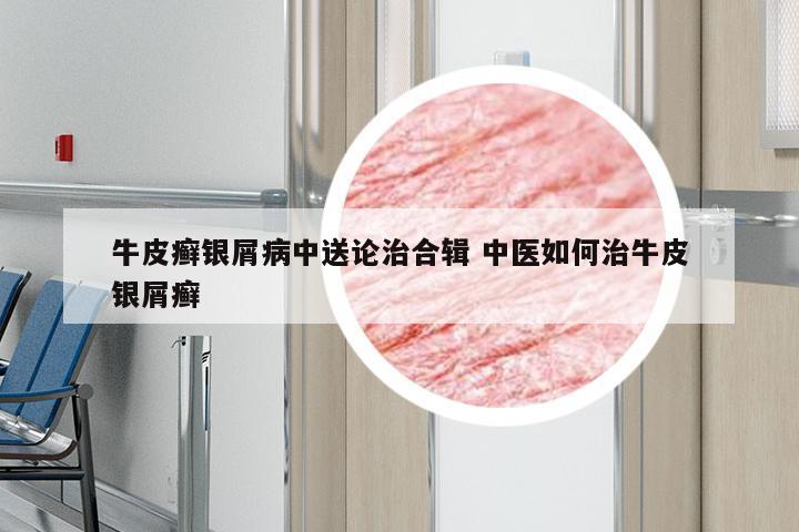 牛皮癣银屑病中送论治合辑 中医如何治牛皮银屑癣
