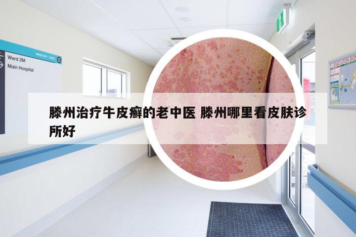 滕州治疗牛皮癣的老中医 滕州哪里看皮肤诊所好