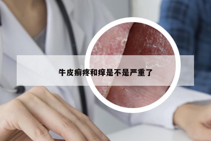 牛皮癣疼和痒是不是严重了