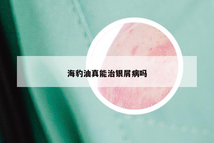 海豹油真能治银屑病吗