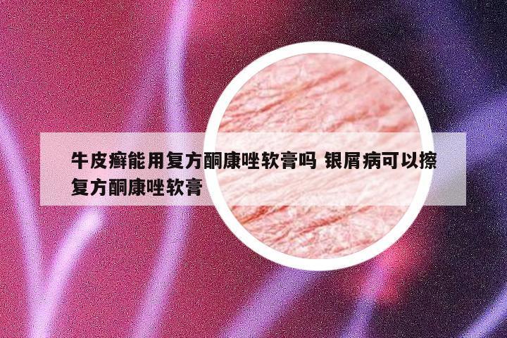 牛皮癣能用复方酮康唑软膏吗 银屑病可以擦复方酮康唑软膏