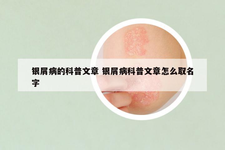 银屑病的科普文章 银屑病科普文章怎么取名字