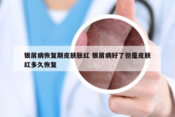 银屑病恢复期皮肤胀红 银屑病好了但是皮肤红多久恢复