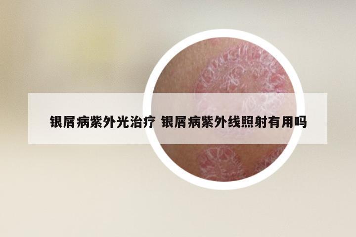 银屑病紫外光治疗 银屑病紫外线照射有用吗