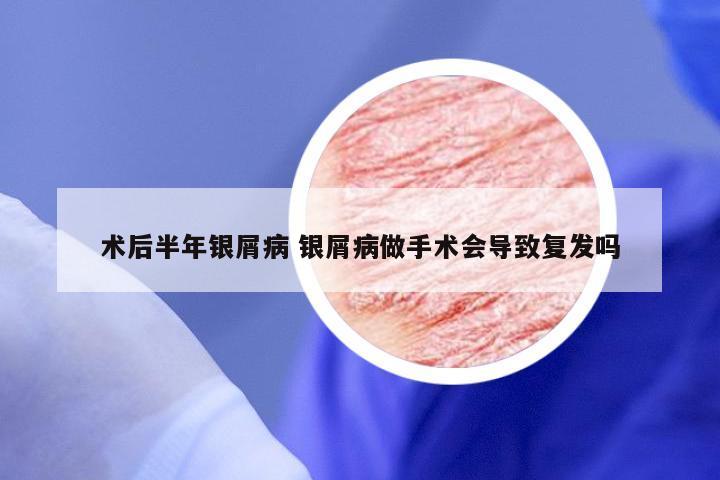 术后半年银屑病 银屑病做手术会导致复发吗