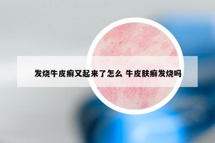 发烧牛皮癣又起来了怎么 牛皮肤癣发烧吗