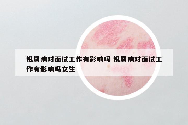 银屑病对面试工作有影响吗 银屑病对面试工作有影响吗女生