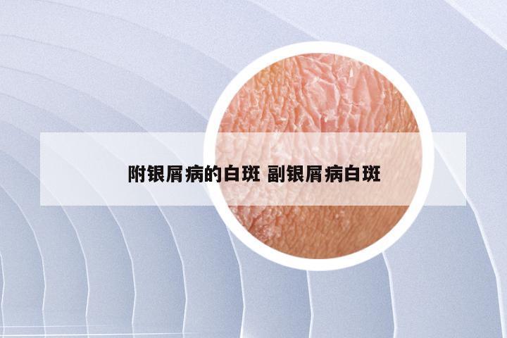 附银屑病的白斑 副银屑病白斑