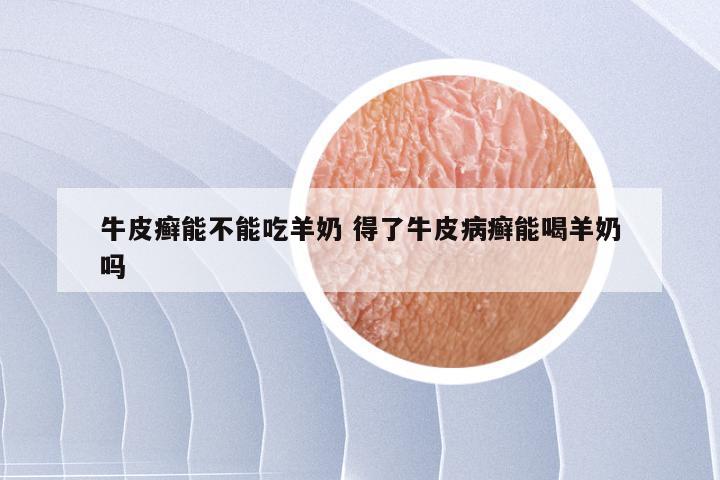 牛皮癣能不能吃羊奶 得了牛皮病癣能喝羊奶吗