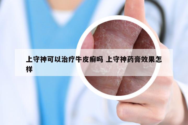 上守神可以治疗牛皮癣吗 上守神药膏效果怎样