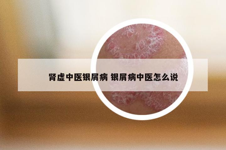肾虚中医银屑病 银屑病中医怎么说