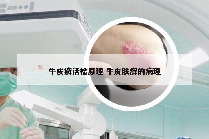 牛皮癣活检原理 牛皮肤癣的病理