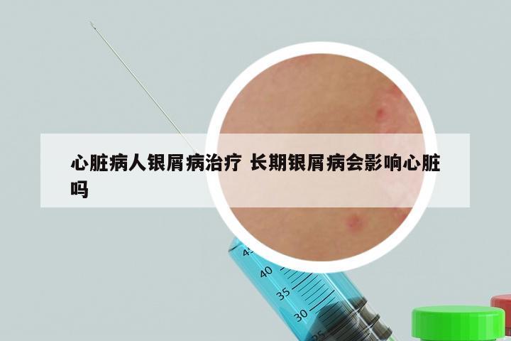 心脏病人银屑病治疗 长期银屑病会影响心脏吗
