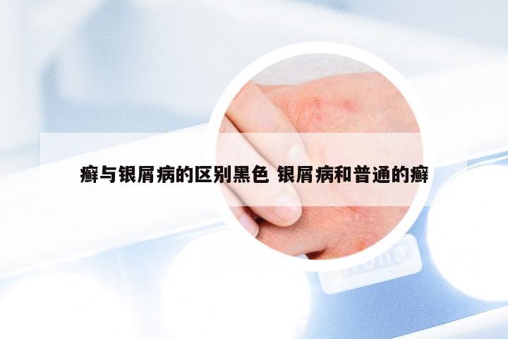 癣与银屑病的区别黑色 银屑病和普通的癣