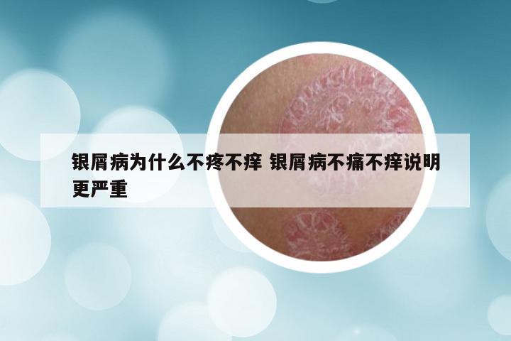 银屑病为什么不疼不痒 银屑病不痛不痒说明更严重
